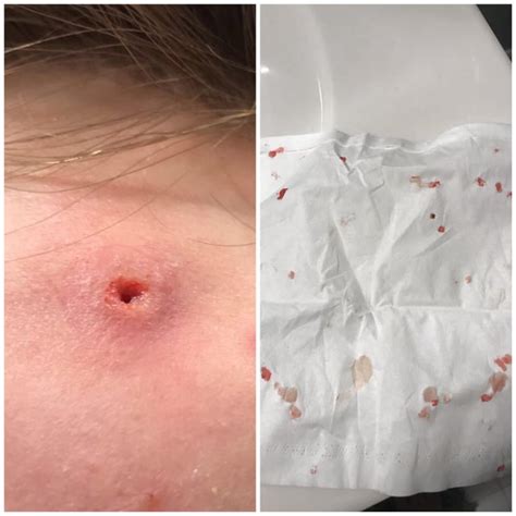 Incision care refers to a series of procedures and precautions related to closing a wound or surgical incision; protecting the cut or injured tissues from contamination or infection; and caring properly for the new skin that forms during the healing process. . Scab fell off and left a hole